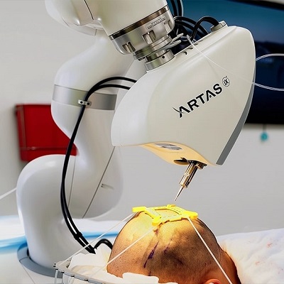 Robotic Hair Transplant Cost in Dubai