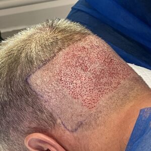 Does Hair Transplant Leave Scars