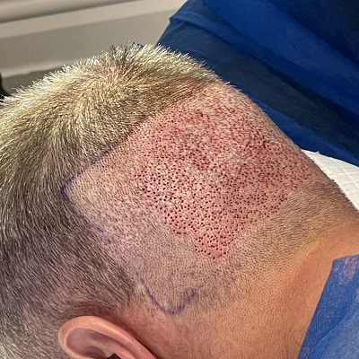 Does Hair Transplant Leave Scars