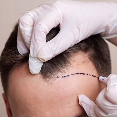 Hybrid Hair Transplant Cost in Dubai