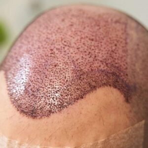 FUE Hair Transplant Recovery Timeline
