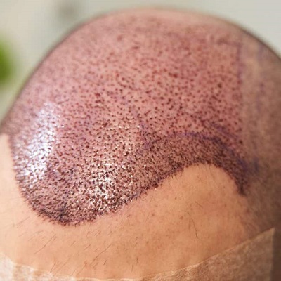 FUE Hair Transplant Recovery Timeline