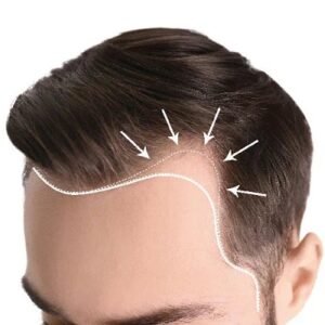 How Can I Regrow My Hairline?
