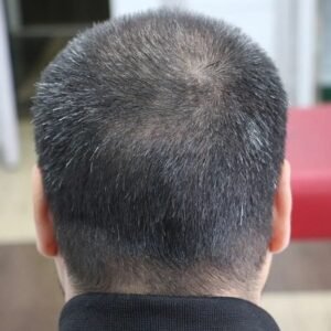 Importance of the Donor Area in Hair Transplant