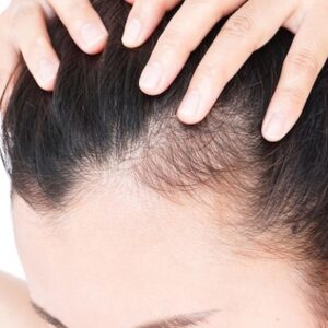 Non-Surgical Hair Regrowth