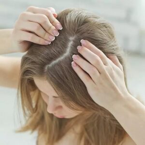 What Causes Hair Loss in Women