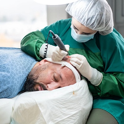 Hair Transplant Cost in Dubai