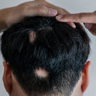 Scarring vs Non-scarring Alopecia