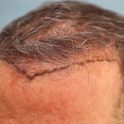 Second Hair Transplant for Density