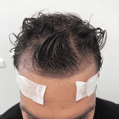 How to Prevent Infections After Hair Surgery